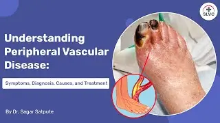 Understanding Peripheral Vascular Disease: Symptoms, Causes, and Treatment | Dr Sagar Satpute(Hindi)