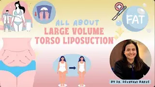Dr. Devayani Barve | Large Volume Torso Liposuction Transformation | Before & After Results
