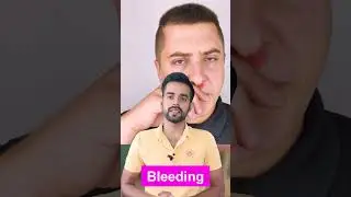 Stop Nose Bleeding Quickly | नकसीर बंद करने का तरीका | #shorts
