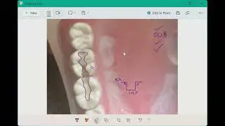Mastering Proximal Contact & Box Depth for ADEX Exam Prep | ADEX Exam Tips