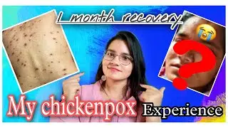 My chickenpox experience | Before & After | 1 month recovery | Doll Neha