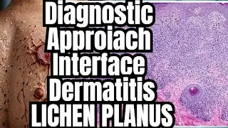 Lichenoid interface dermatitis,LP,LDE,LK, BLK, LPLK,Pityriasis lichenoides, Lichen striatus,LichenPL