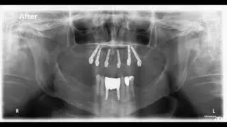 Full Upper Implant Rehabilitation
