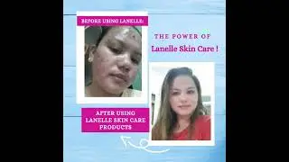 Lanellista in Taiwan Before & After Using Lanelle Skin Care by Lanelle Milanie Torralba