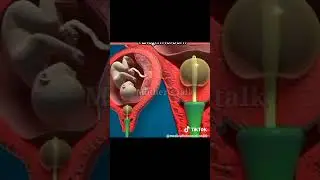 Cervical Foley's induction method during delivery #pakistan #gynecologist #obstetrics #youtube