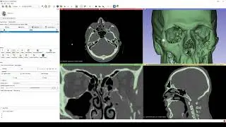 Part 1 - Using 3D Slicer to create a human skull and orbit model from a CT scan - SIMPLE METHOD