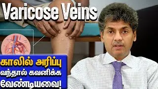 Varicose Veins &ndash; காலில் அரிப்பு வந்தால் கவனிக்க வேண்டியவை! | Dr Bala Kumar