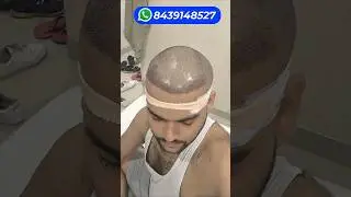 Fastest 4 Month's Hair Transplant Ever 🔥🔥🔥 #hairtransplantresults