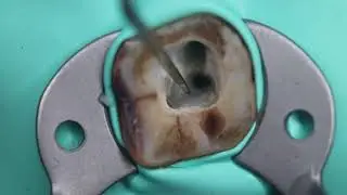 access opening 🔵 attrited mandibular molar 🟠 protaper gold dentsply 🟣 Now live streaming