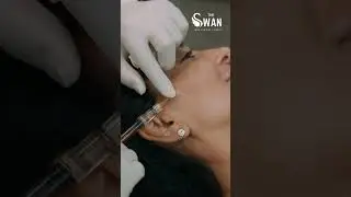 Skin Booster Treatment with Ejal 40 Hyaluronic