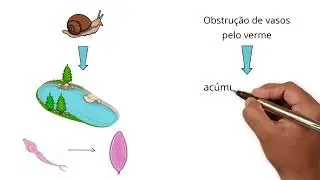 Parasitose intestinal - Esquistossomose