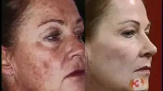 Active Fx - Laser Resurfacing for Better Looking and Healthier Skin