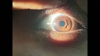 Protruding Iris Collarette