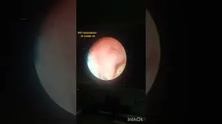 Foreign body (Battery Cell) removal using Optical Forceps