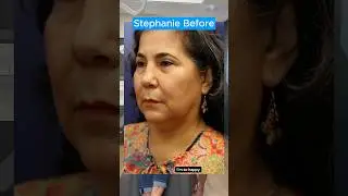 My PERFECT Facelift 2 Year Update (Interview)