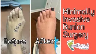 MInimally Invasive Bunion Surgery (MIS)