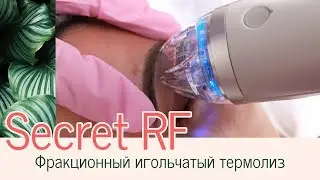 Микроигольчатый RF-лифтинг, аппарат Secret RF