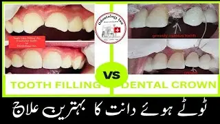 TOOTH FRACTURE TREATMENT BY TOOTH-COLORED COMPOSITE FILLING VS DENTAL CROWN