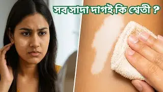 সাদা দাগ শ্বেতী কিনা বুঝবেন কীভাবে? ঘরোয়া ৩টি পরীক্ষায় জেনে নিন।White spot #facts