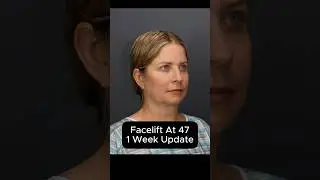 Facelift At 47 - 1 Week Update (Interview) #facelift