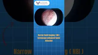 Early Detection Matters in Bladder Cancer | Best Urologist | Dr Nitin Negi#urinaryhealth #doctor