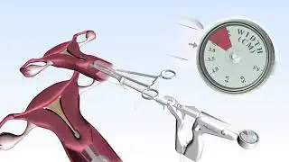 NovaSure 3D Procedure Animation and RF Controller Set Up