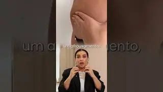Terapia Manual ou Tecnologia? A Resposta Est&aacute; na Avalia&ccedil;&atilde;o da Fibrose #fibrosis #p&oacute;soperat&oacute;rio #lipo
