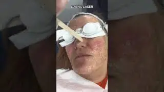 How is Thread Veins on the face treated? | DrMedispa