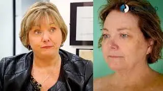 My Facelift Experience: Susan Phipps | Vida Wellness & Beauty | Tijuana