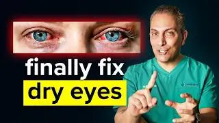 The Ultimate Dry Eye Treatment Guide (From Mild to Severe Cases)