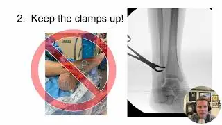 Fibular nailing tips and tricks