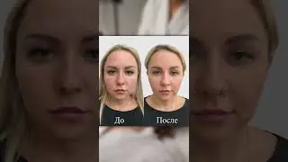 ULTHERA-терапия &mdash; единственный аналог пластической хирургии🤍