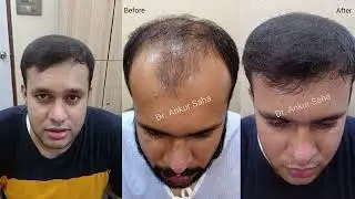 Before and After Hair Transplant Result | Client's Testimonial | Enhance Hair And Skin Clinic
