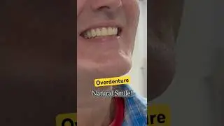 Putting on an overdenture is this fast! #overdentures #implant #dentures