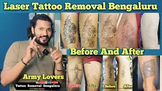 Laser Tattoo Removal 100% Result Befor and After | Best Tattoo Removal in Bengaluru #tattooremoval