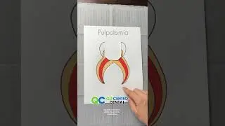 Pulpotomy or pulpectomy?