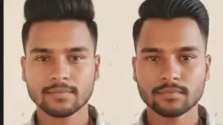 Hair transplant 😷😯😯😯😯