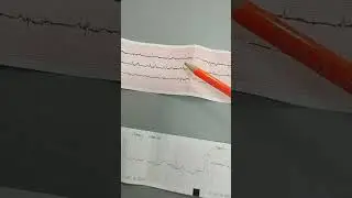 Doktor Elxan Sədirovun izahında EKQ lentləri.