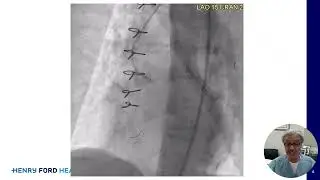 How to manage difficult engagement with the coronary guide catheter
