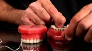 How Do You Floss With Braces? | Friday Focus | E&S Orthodontics