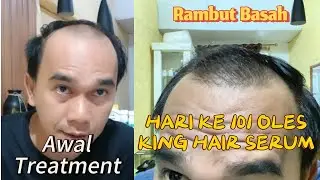 HARI KE 101 OLES KING HAIR SERUM. LUMAYANLAH ADA PERTUMBUHAN. RAMBUT APA ADANYA😁