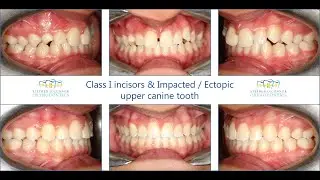 Class I occlusion & Impacted upper canine tooth - Surgical exposure & metallic fixed braces