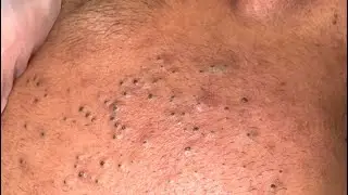 Daily Facial Care Routine | Deep Pore Cleansing for Acne & Blackhead Removal