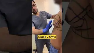 Grade 2 Gynecomastia Surgery | Fat and Gland Removal Procedure! | Dr DC, Pune
