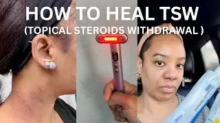 TSW| RED LIGHT THERAPY, NO MOISTURIZER, After Affects.. HOW TO HELP/MANAGE With The Inflammation.