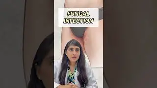 Ringworm?| Ringworm treatment | How to get rid of ringworm| Fungal infection|Don't use home remedies
