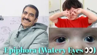 Eye | Epiphora in Children (Watery Eyes 👀 ) | By Prof. Dr. Ejaz Javed Lak 