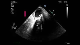 Abdominal Aortic Aneurysm. Don't forget about the abdominal aorta during echocardiography #Tętniak