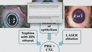 AIOC2018 - FP968 - Cornea - II - Topic - 
