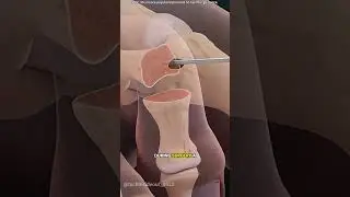 Hammertoe Repair Surgery #adventure #doctor #3danimation #music #science #animation #relaxingmusic